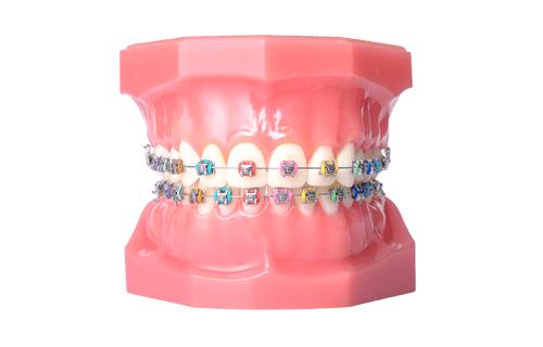 White Rubber Bands on Braces - Hawaiian Smiles Orthodontics