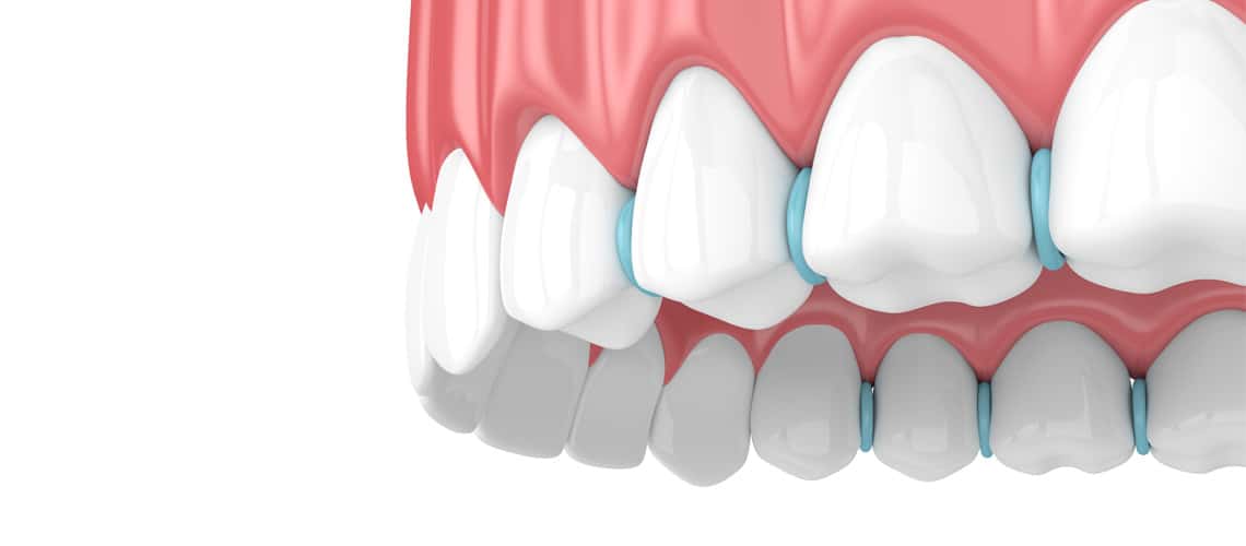 Orthodontic Separator Instructions Stormberg Orthodontics San Diego