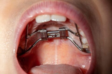 Palatal Expander