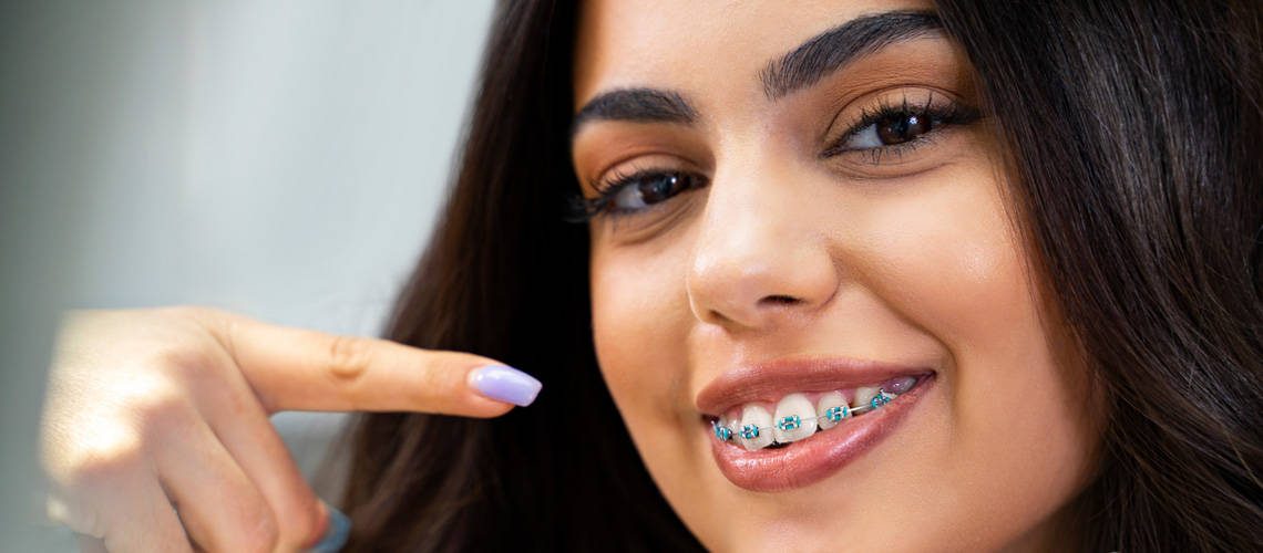 Braces colors — show off your personality with color! How to pick the
