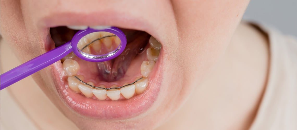 How to care for your fixed bonded retainer Bonded fixed wire retainer