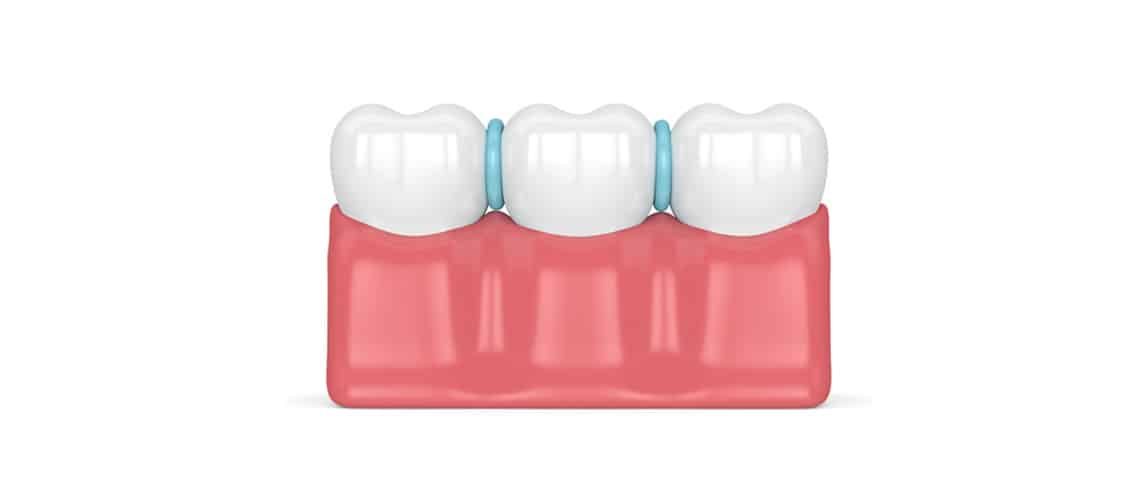 What are spacers for braces and how do they work? Orthodontic