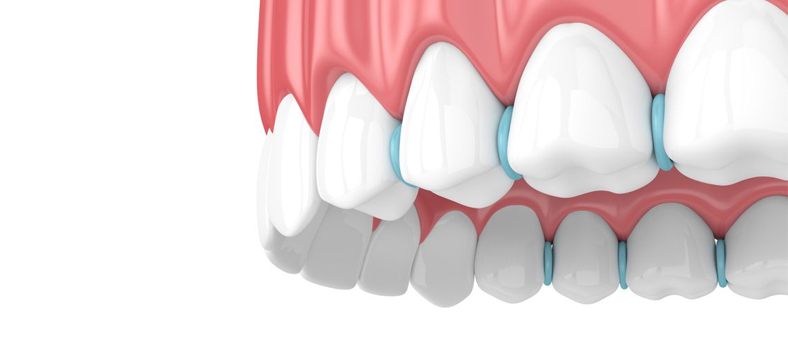 Orthodontic Separator Instructions Stormberg Orthodontics San Diego